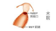 术前