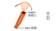 术后